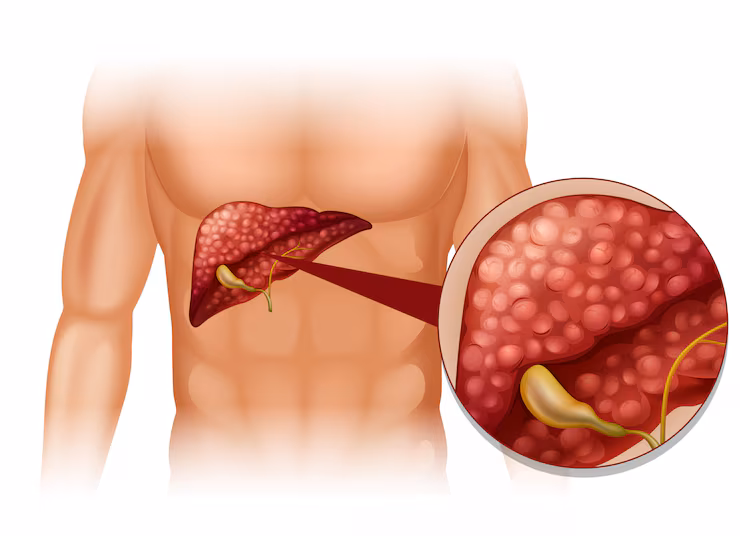 Adrenal Tumors